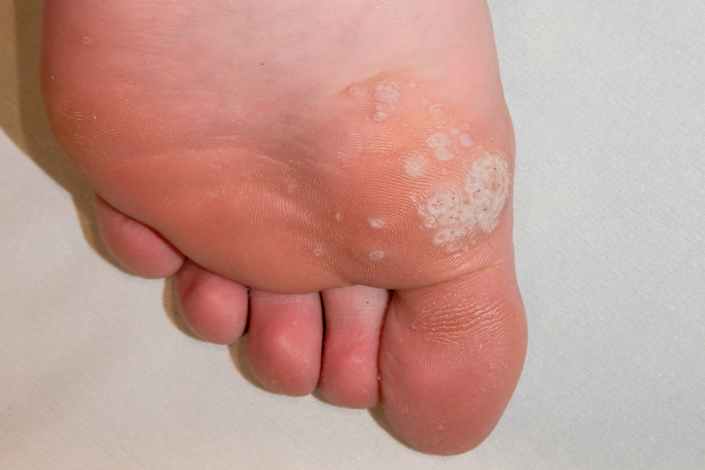 mosaic plantar warts on bottom of foot