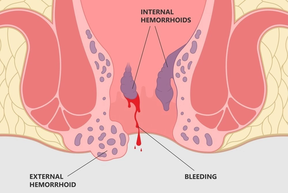 diagram of anus showing internal and external hemorrhoids